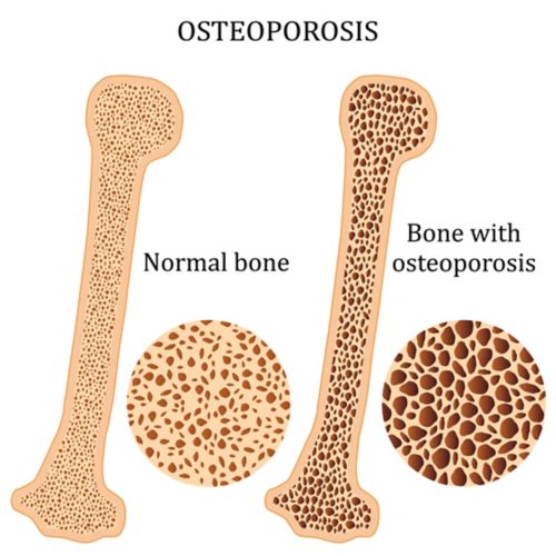 Graphique représentant deux os avec la masse osseuse apparente. À gauche, la densité osseuse est normale. À droite, la densité osseuse est plus poreuse, ce qui indique une ostéoporose.