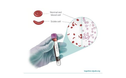 Medical illustration depicting both normal red blood cells and sickle cells