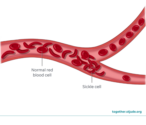 illustration showing normal red blood cells and sickle cells in a blood vessel