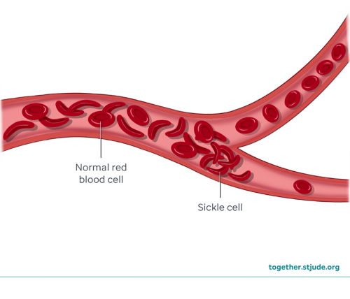 ilustración que muestra glóbulos rojos normales y células falciformes en un vaso sanguíneo