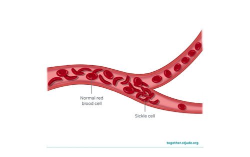 Illustration showing normal red blood cells and sickle cells within a blood vessel