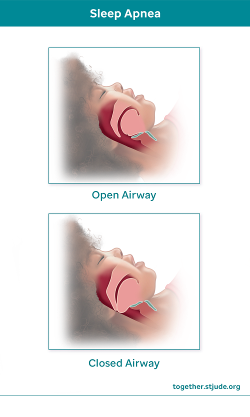 An open area versus a closed airway