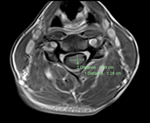 Una IRM del plano axial de la columna vertebral muestra un tumor en un paciente pediátrico
