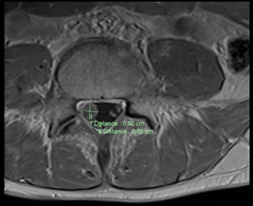 تصوير بالرنين المغناطيسي مقطع محوري من العمود الفقري يظهر ورمًا في طفل مريض