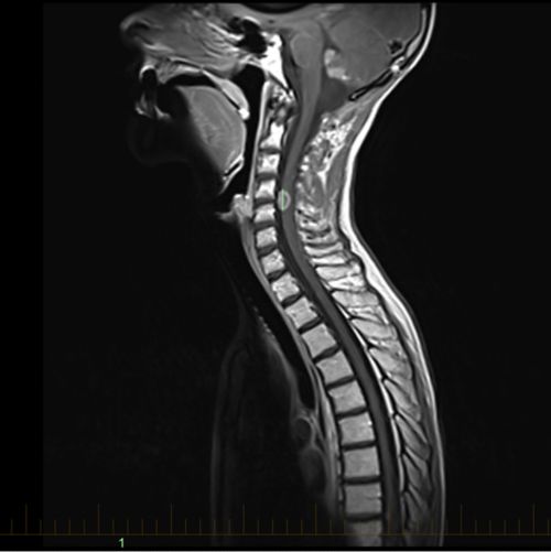 RM mostra um tumor medular no pescoço de um paciente pediátrico