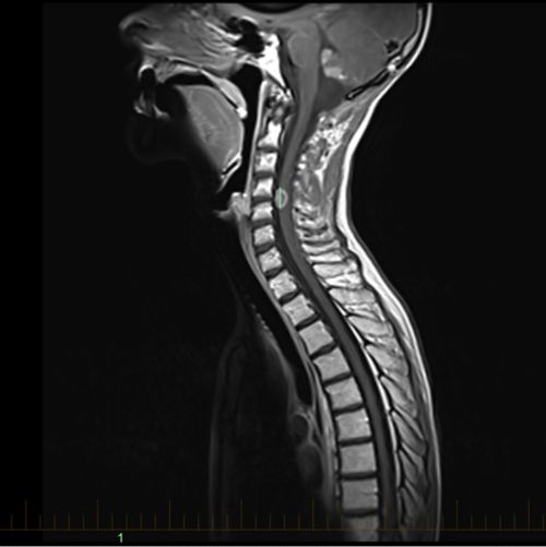 MRI သည် ကလေးလူနာတစ်ဦး၏လည်ပင်းရှိ ကျောဆစ်ရိုးတွင်း အာရုံကြောမကြီးအကျိတ်တကျိတ် ကိုပြသည်