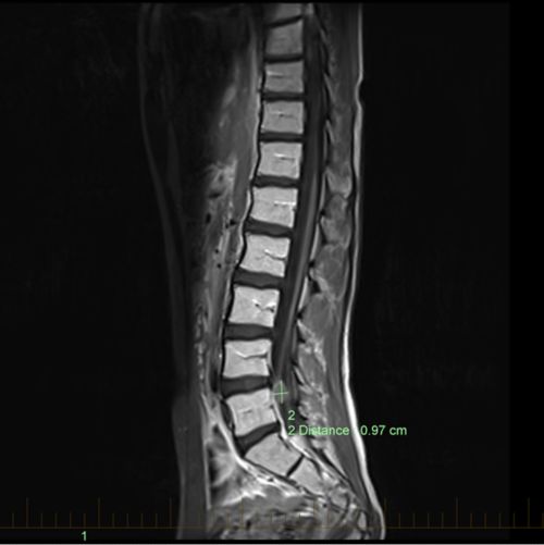 MRI သည် ကလေးလူနာတစ်ဦး၏ ကျောအောက်ပိုင်းရှိ ကျောဆစ်ရိုးတွင်း အာရုံကြောမကြီးအကျိတ်တကျိတ် ကိုပြသည်