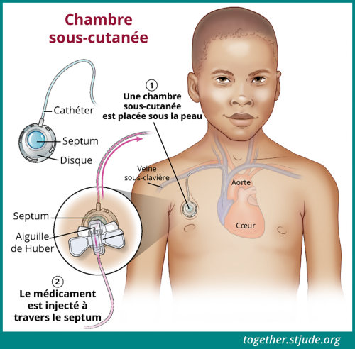 Cette illustration montre un enfant avec une chambre implantée dans la veine sous-clavière. Les parties de la chambre sont étiquetées : cathéter, septum, disque et aiguille Huber. Une vue rapprochée de la chambre montre une aiguille Huber qui y accède. Les aiguilles Huber permettent d'injecter les médicaments à travers le septum.