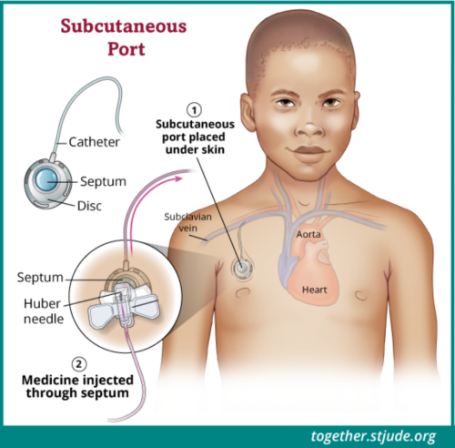 This illustration shows a child with a port placed into the subclavian vein. Parts of the port are labeled: catheter, septum, disc, and the Huber needle. A close-up of the port shows a Huber needle accessing the port. Huber needles allow medicine to be injected through the septum.