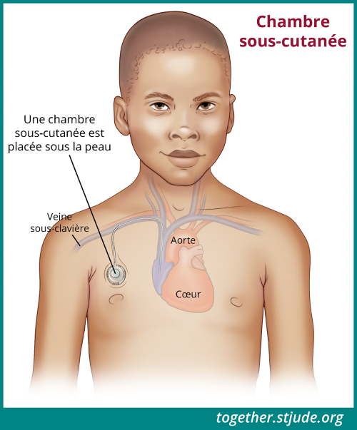 Un cathéter veineux central peut être utilisé pour prélever des échantillons de sang, administrer une chimiothérapie, des liquides, des électrolytes, des antibiotiques et d'autres médicaments ainsi qu'alimenter le patient par voie parentérale. Cette illustration montre un exemple de chambre sous-cutanée.