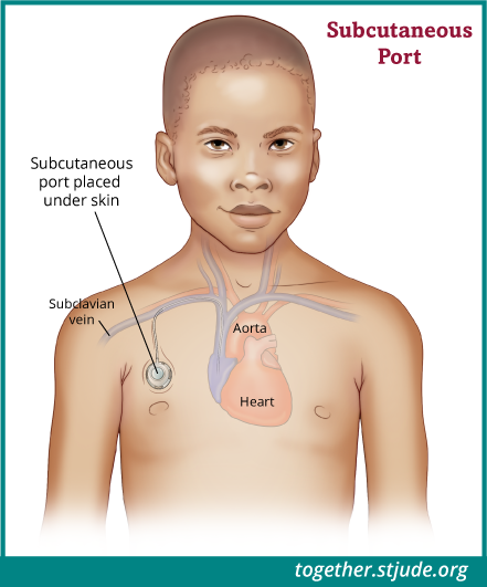 A central venous catheter can be used to take blood samples, administer chemotherapy, give fluids and electrolytes, provide parenteral nutrition, and give antibiotics and other medicines. This illustration shows an example of a subcutaneous port.