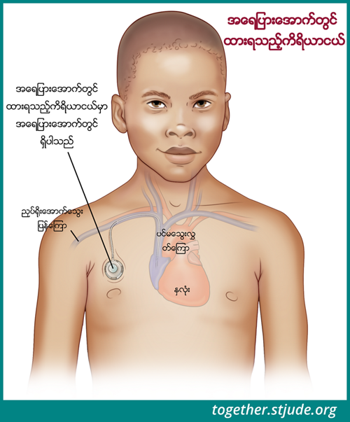 သွေးနမူနာများရယူရန်၊ ကီမိုဆေးသွင်းခြင်း ကုထုံးဆေးသွင်းရန်၊ အရည်နှင့် ဓာတ်ဆားများပေးသွင်းရန်၊ သွေးပြန်ကြောမှတဆင့် အာဟာရဓာတ်ပေးရန် နှင့် ပဋိဇီဝဆေးများနှင့် အခြားဆေးဝါးများ ပေးသွင်းရန်တို့အတွက် ပင်မသွေးပြန်ကြောပိုက်ကို အသုံးပြုနိုင်သည်။ ဤသရုပ်ဖော်ပုံတွင် အရေပြားအောက်ရှိ ပင်မသွေးပြန်ကြော ဝင်ထွက်ပေါက်ပိုက်တစ်ခု၏နမူနာ ကို ပြသထားပါသည်။