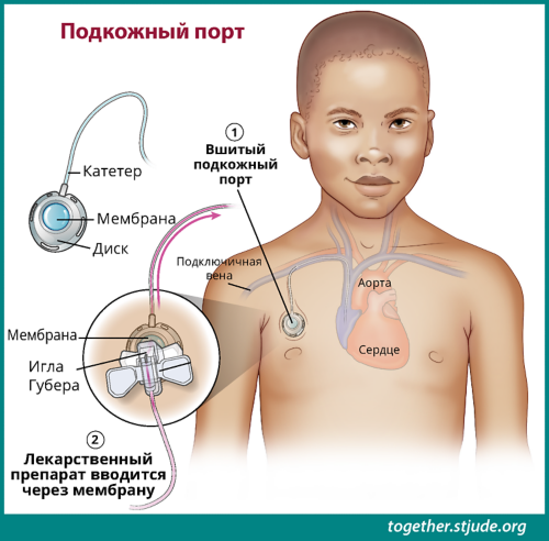 Подкожная порт-система - Ezgu Amal