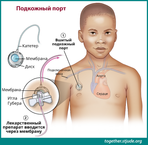 На этом рисунке изображен ребенок с порт-системой, размещенной в подключичной вене. Обозначены детали порт-системы: катетер, мембрана, диск и игла Губера. На увеличенном изображении порт-системы показано, как игла Губера подсоединяется к порт-системе. Иглы Губера позволяют вводить лекарственный препарат через мембрану.