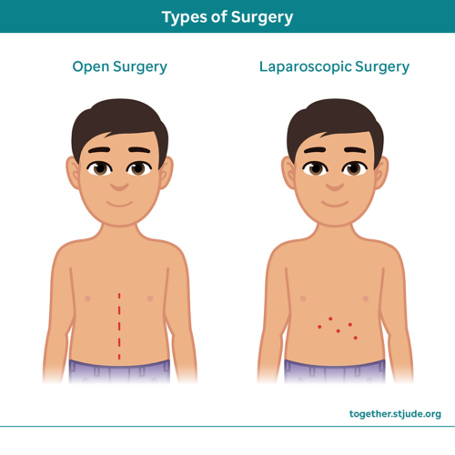 Types of surgery, open surgery and laparoscopic surgery