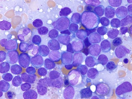 image of lymphoblastic lymphomm