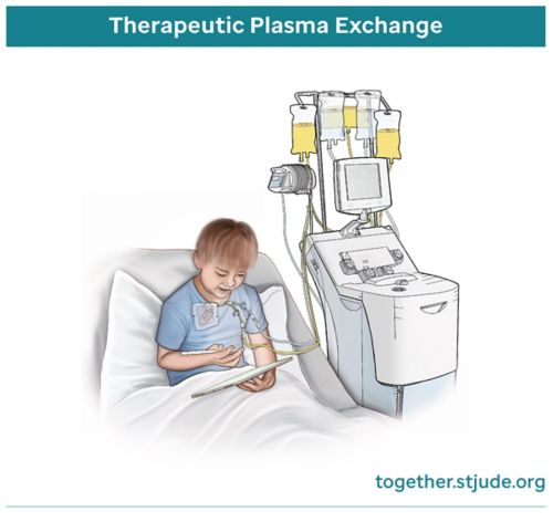 Ilustración médica de un niño que recibe un intercambio terapéutico de plasma en una cama hospitalaria con una vía IV conectada al brazo.