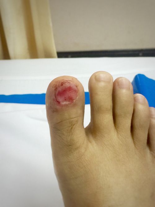 Surgery for ingrowing toenail (child)