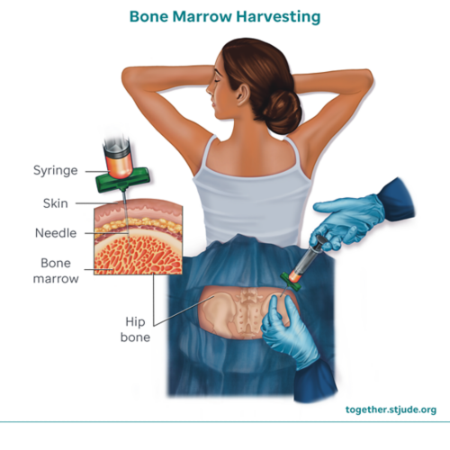 Bone marrow is collected using a hollow needle attached to a syringe.