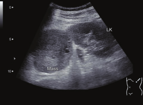 Obraz ultrasonograficzny przedstawiający masę w nadnerczu.