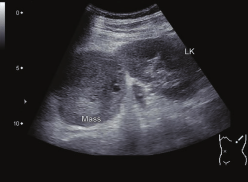 Ultrasonido que muestra una masa en una glándula suprarrenal.