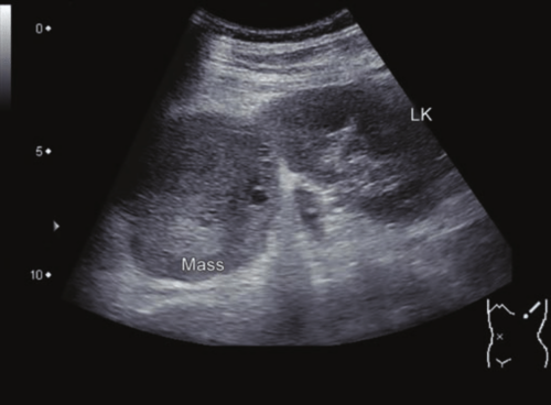 kidney ultrasound tumor