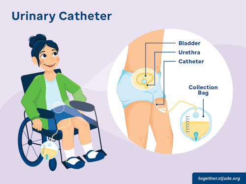 use of indwelling catheters