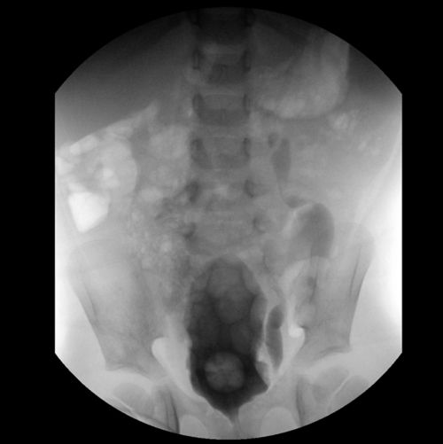 A imagem de raios X mostra o início do exame de VCUG em um paciente com câncer pediátrico. 