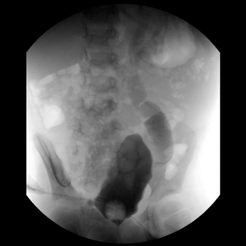O raio X mostra a progressão do teste de VCUG em um paciente com câncer pediátrico.