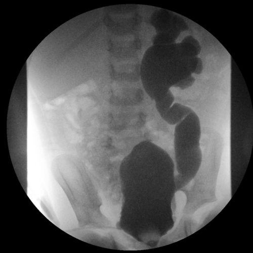 O raio X mostra progressão adicional do teste de VCUG em um paciente com câncer pediátrico.