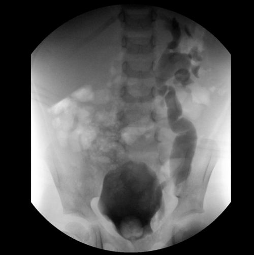 Los rayos X muestran la última parte de una serie de la prueba de VCUG en un paciente con cáncer pediátrico.