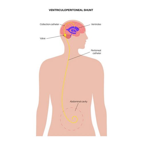 Ventriculoperitoneal (VP) shunt