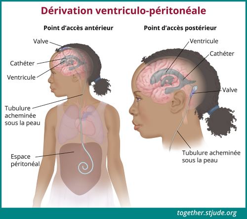 Ces illustrations montrent une fille avec un shunt. Les différentes versions montrent à quoi ressemble le shunt lorsqu'il est orienté vers l'avant du corps ou vers l'arrière du corps. L'illustration comporte une légende permettant d'identifier les pièces du dispositif : valve, cathéter, tubulure. Un ventricule du cerveau et l'espace péritonéal où le shunt procède au drainage sont également identifiés.