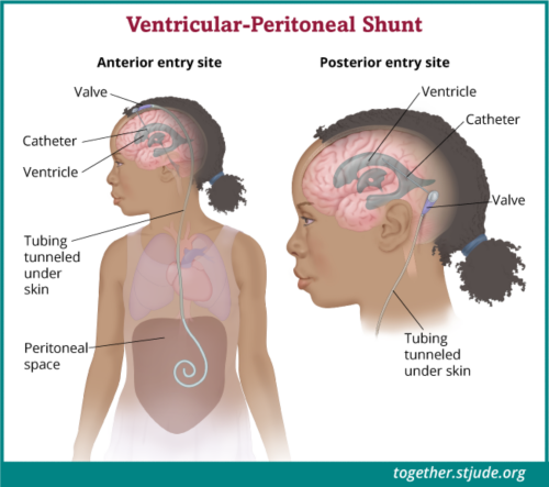 Alguns pacientes com pineoblastoma terão cirurgia para colocar um shunt (derivação) para prevenir hidrocefalia. Um shunt (derivação) é um tubo pequeno que drena o líquido cefalorraquidiano para que possa ser removido do cérebro.