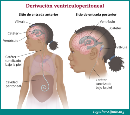 Una derivación es un pequeño tubo que drena el líquido cefalorraquídeo para evitar que se acumule en el cerebro. Este líquido aumenta la presión dentro del cerebro y puede causar otros síntomas de tumores de plexo coroideo.