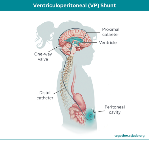 A shunt is a small tube that drains cerebrospinal fluid to keep it from building up in the brain. This fluid causes increased pressure inside the brain and may cause other symptoms of choroid plexus tumors.