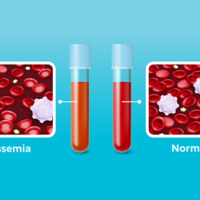 Thalassemia illustration