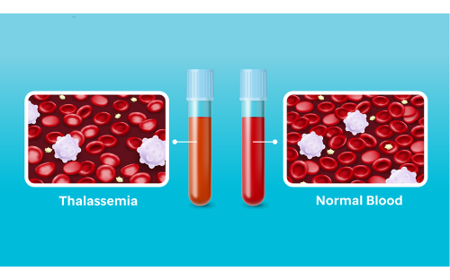 Thalassemia illustration