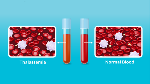 Thalessemia illustration