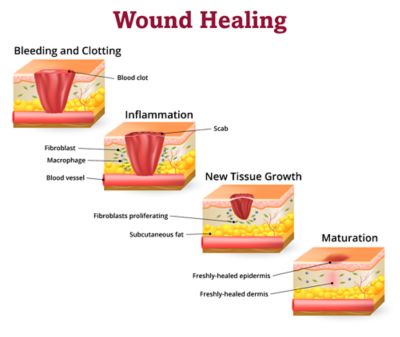 Delayed Wound Healing In Children With Cancer - Together By St. Jude™