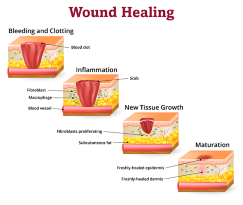 Impaired wound healing