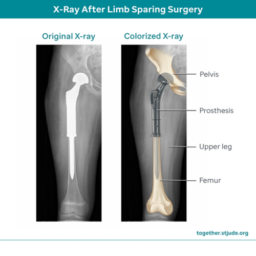 X-ray after limb sparing surgery