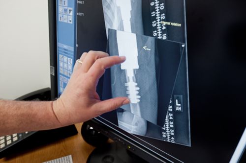 X-ray with prosthesis on screen being reviewed