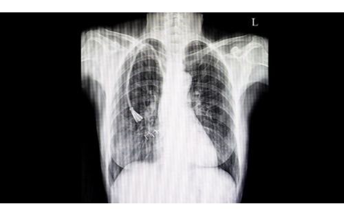 X-ray of a chest with a central line