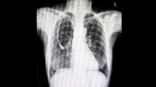 X-ray showing central line on left side.