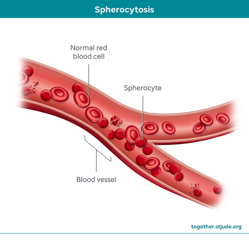 illustration of spherocytosis