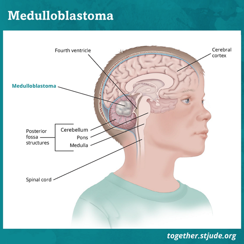 Os tumores na região da fossa posterior representam mais da metade de todos os tumores cerebrais em crianças. Cerca de 25% das crianças que fazem cirurgia para remover o meduloblastoma, um tipo de tumor da fossa posterior, desenvolverão a síndrome da fossa posterior. 