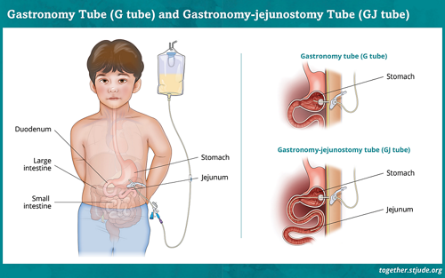 Sonda de gastrostomía y sonda de gastrostomía-yeyunostomía