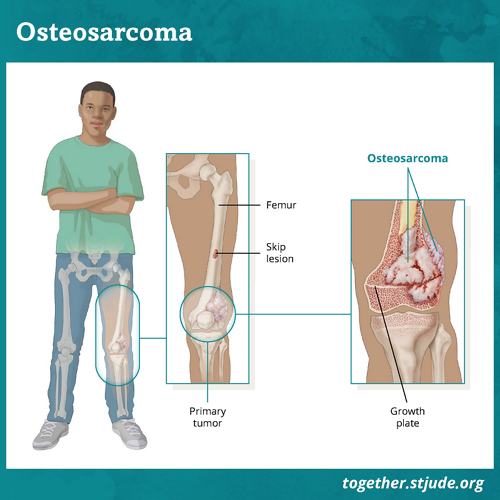 Osteossarcoma é um tipo de câncer ósseo. O osteossarcoma pode se desenvolver em qualquer osso, mas geralmente se forma nas extremidades dos ossos longos da perna ou do braço. Os osteossarcomas podem se formar dentro do osso (tumores centrais) ou na superfície externa do osso (tumores superficiais). A maioria dos osteossarcomas pediátricos é do tipo central, localizada dentro do osso. Exames de imagem, como radiografia, podem ser usados para verificar lesões em salto (skip lesions). Uma lesão em salto ocorre quando o câncer se espalha a partir do tumor primário para outras partes do mesmo osso.