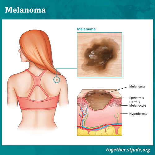Melanoma illustration showing different layers of skin
